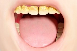 como-quitar-sarro-de-los-dientes