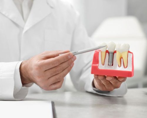 duracion-implantes-dentales
